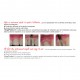 Strumento per la retrazione gengivale GingiProtect GPR3